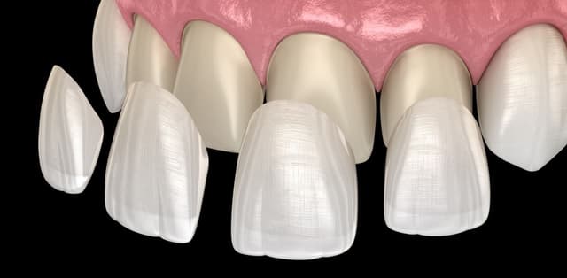 Tìm hiểu ngay, dán sứ sứ veneer là gì?