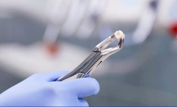 Giá nhổ răng khôn mọc lệch có thể dao động từ vài trăm nghìn cho tới vài triệu đồng