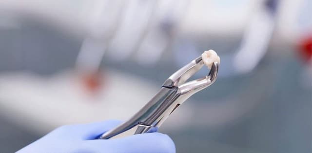 Giá nhổ răng khôn mọc lệch hiện nay cao bao nhiêu?