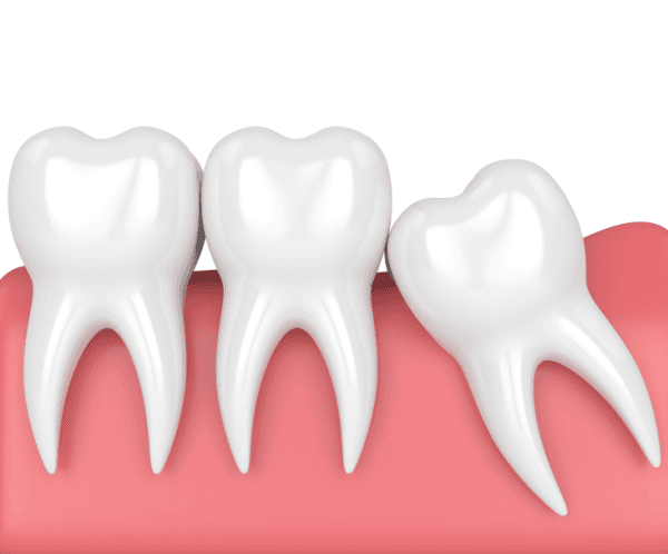 Răng khôn mọc lệch là tình trạng nhiều người gặp phải hiện nay