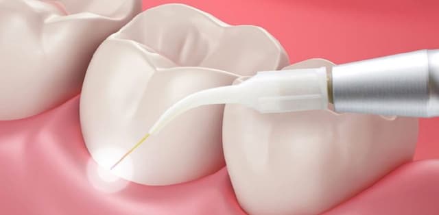 Lấy cao răng: Những điều cần biết nếu muốn sở hữu hàm răng chắc khỏe