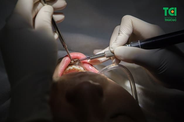 Lấy cao răng có đau không phụ thuộc rất lớn vào tay nghề của người thực hiện