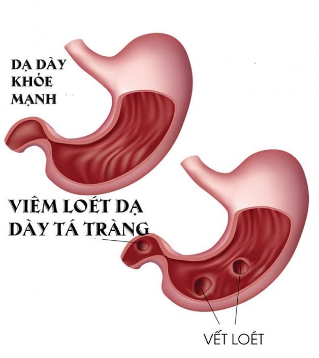 Loét dạ dày chia thành hai giai đoạn: Cấp tính và mãn tính