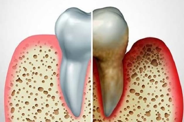 Sưng nướu răng hay còn gọi sưng lợi là tình trạng nướu bị viêm nhiễm, dẫn đến sưng đau, đỏ tấy, và đặc biệt rất dễ bị chảy máu khi có tác động mạnh vào nướu.