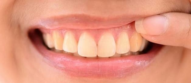 Sưng chân răng là một trong những biểu hiện phổ biến của viêm nướu răng.