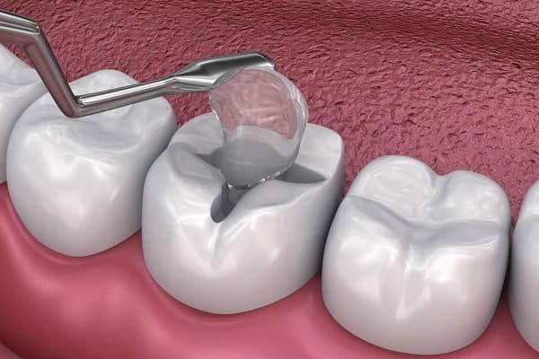 Ở mức độ nhẹ, bác sĩ sẽ tiến hành tái khoáng hoặc bọc răng sứ để khôi phục chức năng của răng