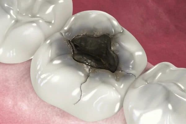 Khi bị sâu, răng số 6 thường xuất hiện các chấm đen, hốc sâu răng trên bề mặt