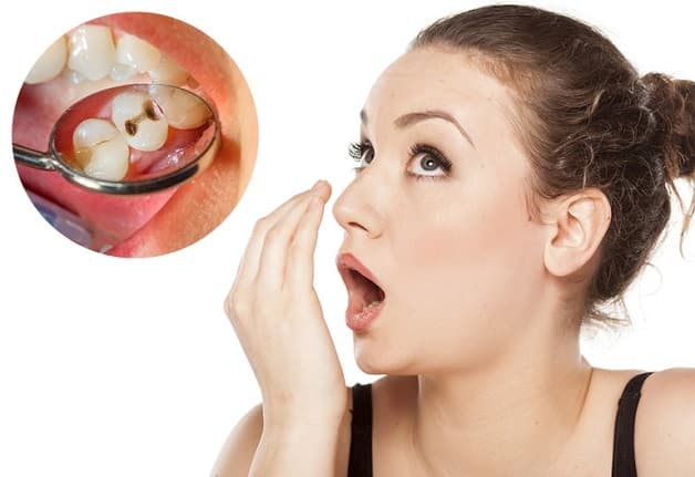Răng sâu gây hôi miệng là tình trạng hơi thở từ miệng thoát ra ngoài có mùi hôi gây khó chịu