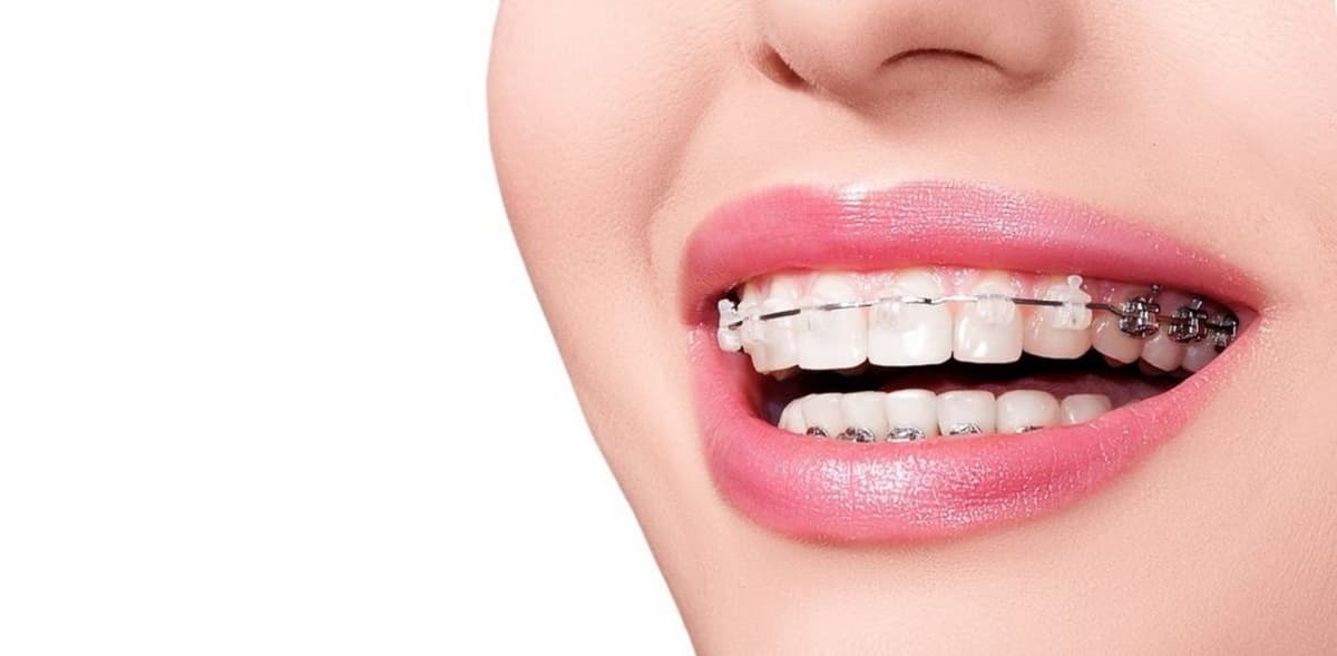 Giải đáp: Sâu răng có niềng răng được không?