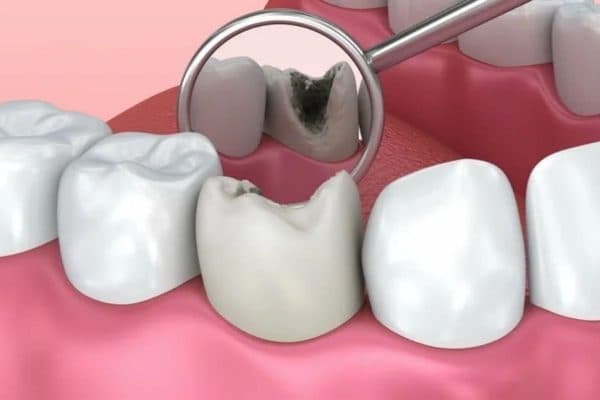 Sâu răng là tình trạng kết cấu mô răng bị phá huỷ bởi các chất có trong thức ăn do nguyên nhân chính là vệ sinh răng miệng thiếu khoa học