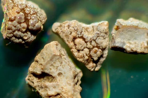 Tán sỏi thận bằng laser áp dụng cho các viên sỏi có kích thước lớn