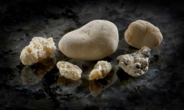 Các sỏi loại sỏi có kích thước lớn và cấu trúc phức tạp thì không thực hiện được phương pháp tán sỏi thận qua da