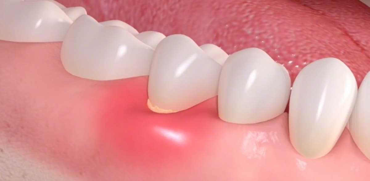 Tìm hiểu về bệnh lý viêm chân răng có mủ