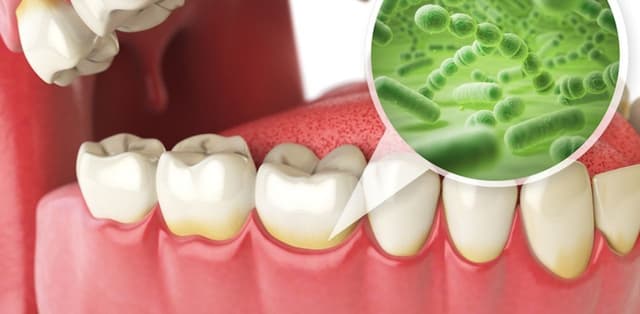 Tìm hiểu về bệnh lý viêm chân răng mãn tính