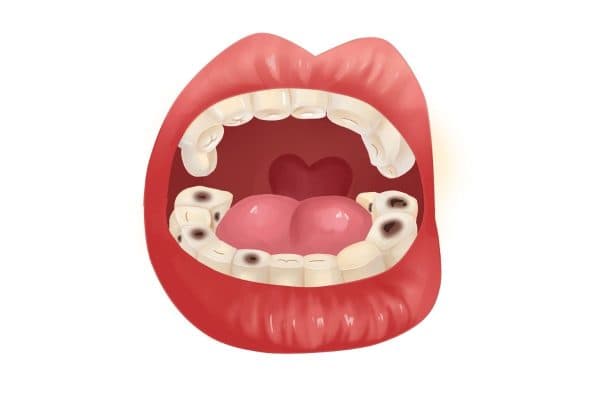 Vi khuẩn là tác nhân chính gây nên tình trạng viêm chân răng mà nhiều người gặp phải