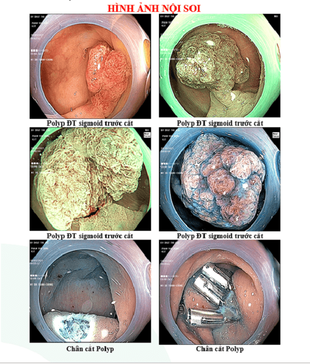 Hình ảnh kết quả sau nội soi