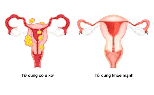 Ăn gì để hết u xơ tử cung – Mẹ bầu cần lưu ý