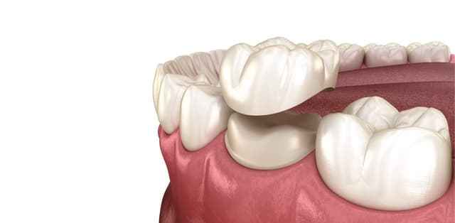 Bác sĩ giải đáp: Bọc răng sứ có phải nhổ răng không?