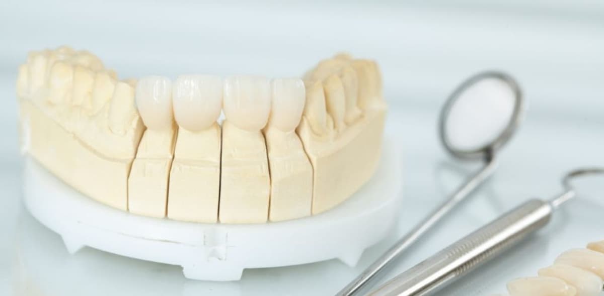 Tìm hiểu tất tần tật về bọc răng sứ titan