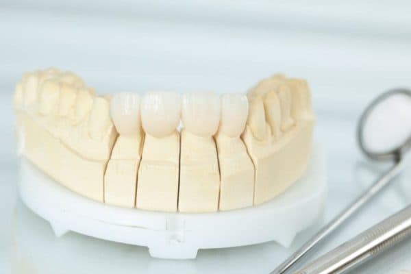 Bọc răng sứ titan giúp phục hình thẩm mỹ cho hàm răng một cách hiệu quả