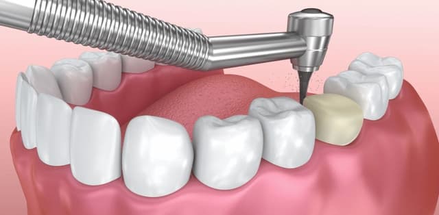 Tìm hiểu về các trường hợp có thể bọc răng sứ