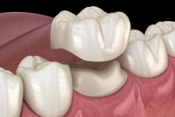 Bọc răng sứ giúp mọi người sở hữu hàm răng đều, đẹp, trắng sáng tự nhiên, cải thiện hình dạng răng như răng thật