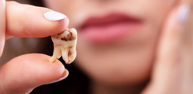 Tìm hiểu các cách chữa viêm chân răng hữu ích