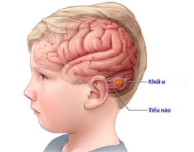 chụp MRI não cho trẻ em