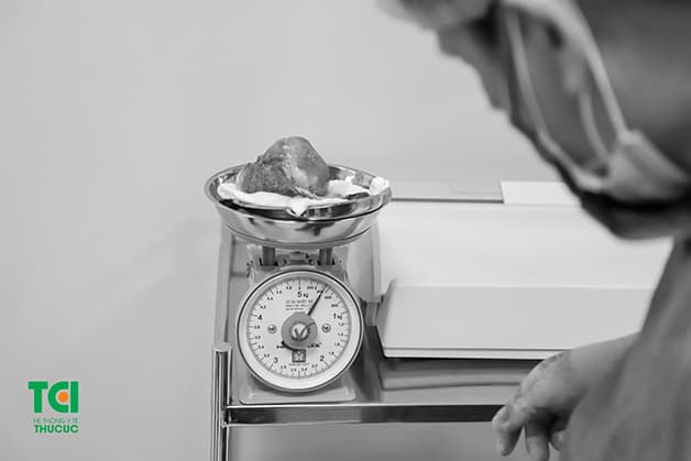 Thành công bóc tách khối u xơ tử cung lớn khỏi cơ thể người bệnh