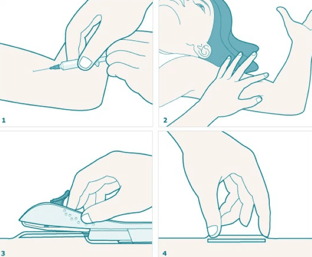 Thủ thuật cấy que tránh thai rất nhanh và hoàn toàn không gây đau đớn.