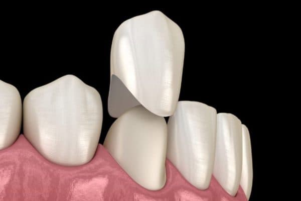 Bọc sứ thường được áp dụng đối với những trường hợp gặp phải một số khiếm khuyết nha khoa như xỉn màu, lệch lạc nhẹ...