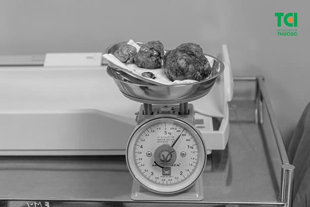 Khối lượng 3 nhân xơ tử cung lên tới 500gr