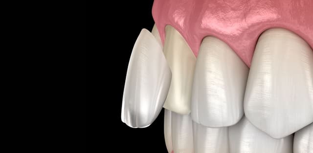 Giải đáp nha khoa: Dán sứ veneer có bền không?