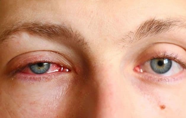 đau mắt đỏ có lây không