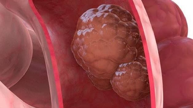 Ung thư là biến chứng vô cùng nguy hiểm