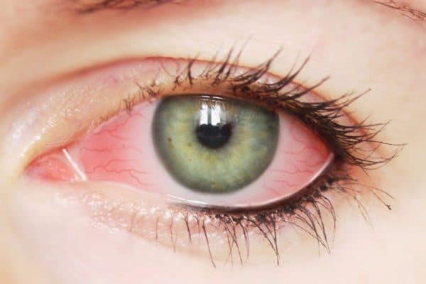 Viêm kết mạc là tình trạng màng kết mạc ở mắt bị viêm do nhiều nguyên nhân như virus, dị ứng...