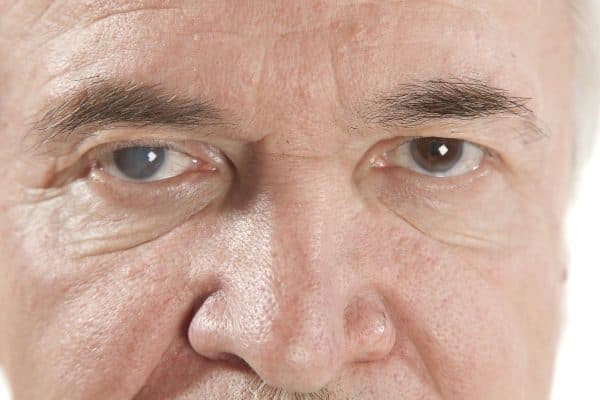 Phần thủy tinh thể bị bệnh về lâu dài sẽ trở nên cứng hơn và dẫn tới viêm, thoái hoá mắt, đồng tử dính lại và rất khó phẫu thuật