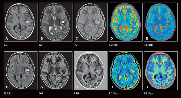chụp MRI đóng vai trò quan trọng