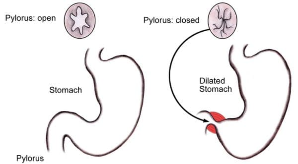 loét hang vị dạ dày gây hẹp môn vị dạ dày