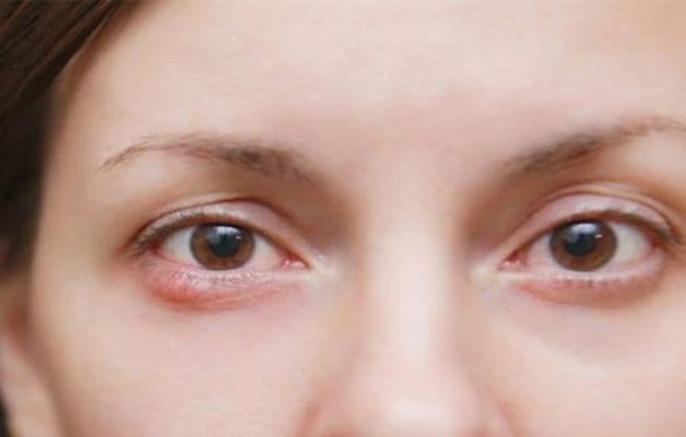 lẹo mắt tái phát