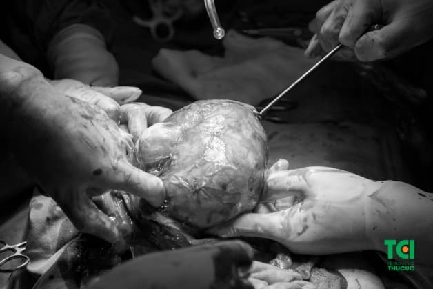 ăn gì sau mổ u xơ tử cung phụ nữ nên biết