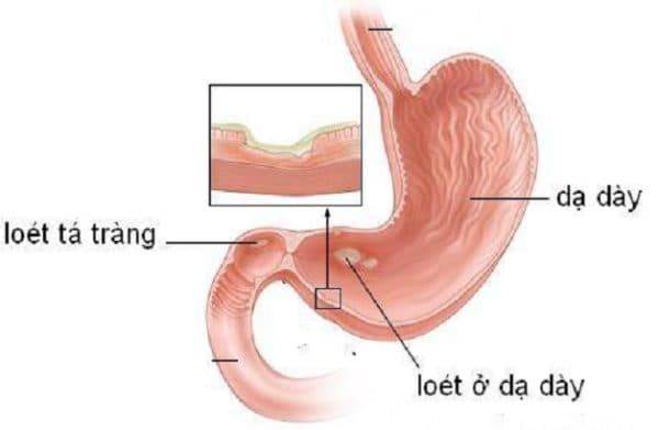 viêm loét dạ dày và nguyên nhân viêm loét dạ dày