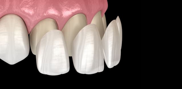 Những lưu ý sau khi bọc răng sứ để giữ tuổi thọ cho răng