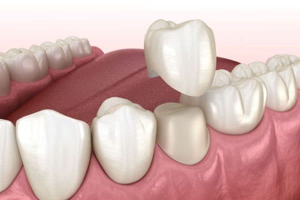 Mão sứ được gắn lên trên bề mặt răng thật đã được mài mỏng nhẹ để phục hình thẩm mỹ cho răng