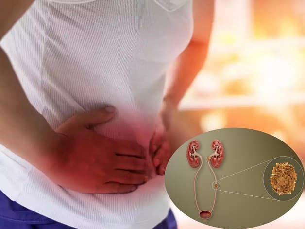 điều trị sỏi niệu quản ⅓ trên như thế nào