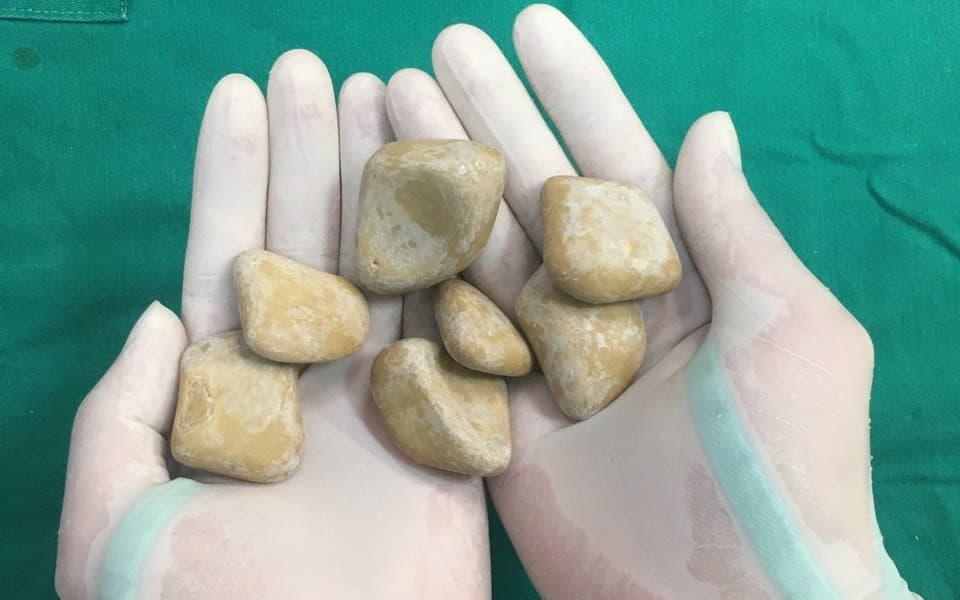 Sỏi ở bàng quang có kích thước và hình dạng khác nhau