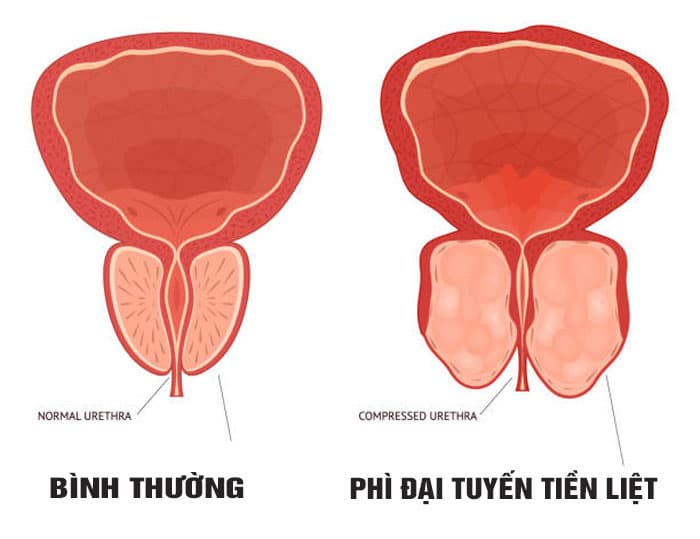 Sỏi tích tụ do phì đại tuyến tiền liệt