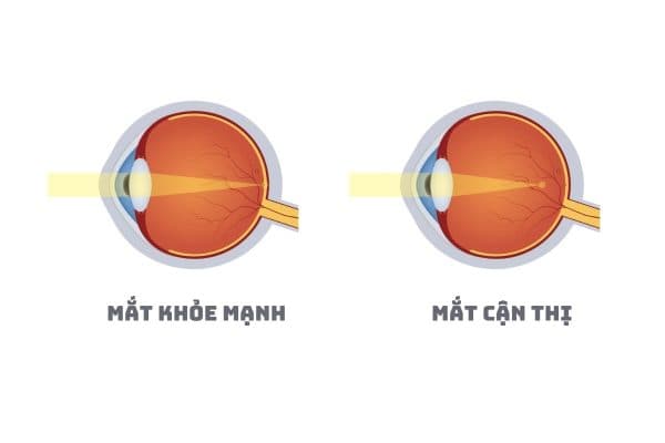 Cận thị là tình trạng điểm hội tụ của tia sáng nằm ở trước võng mạc khiến mọi người chỉ có thể nhìn rõ vật ở gần