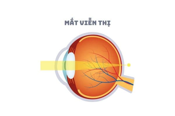 Ánh sáng đi vào mắt hội tụ ở phía sau võng mạc khiến mọi người chỉ nhìn được vật ở xa thì được gọi là viễn thị