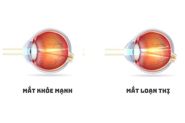 Mắt bị loạn thị khi các tia sáng hội tụ tại nhiều điểm trên võng mạc